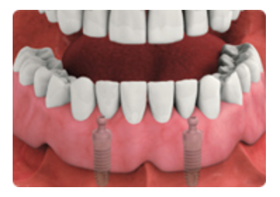 implant Retained overdenture