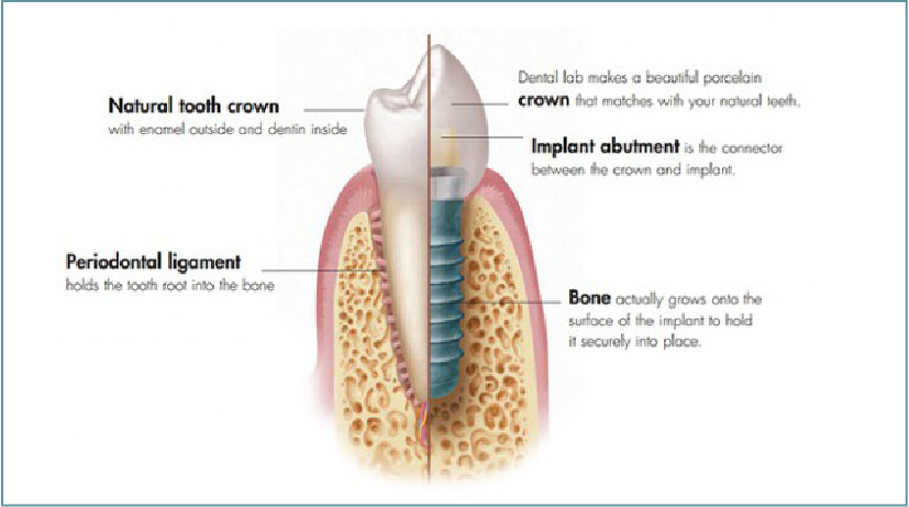 Dental Implants Glasgow