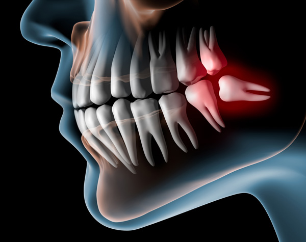 wisdom-teeth-main Cosmetic Dentist Glasgow