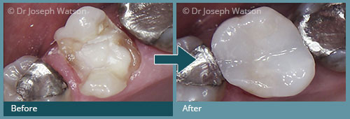 White Fillings Treatment - before and after images in Glasgow