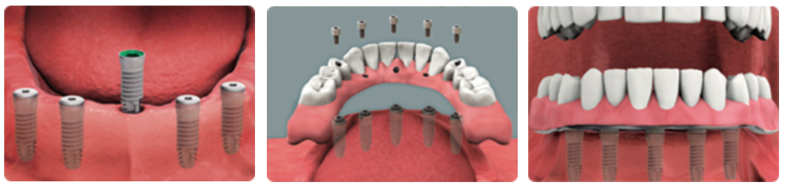 Fixed implant supported restoration