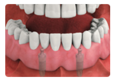 implant-Retained Dentures
