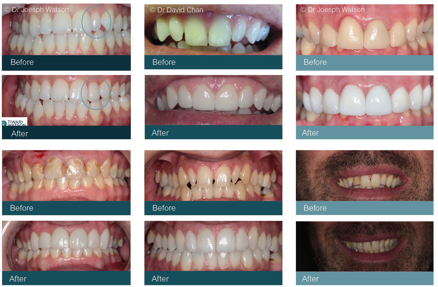 Dental Veneers