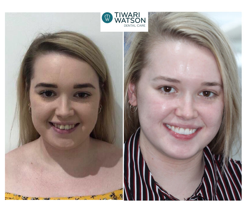 Invisalign Glasgow