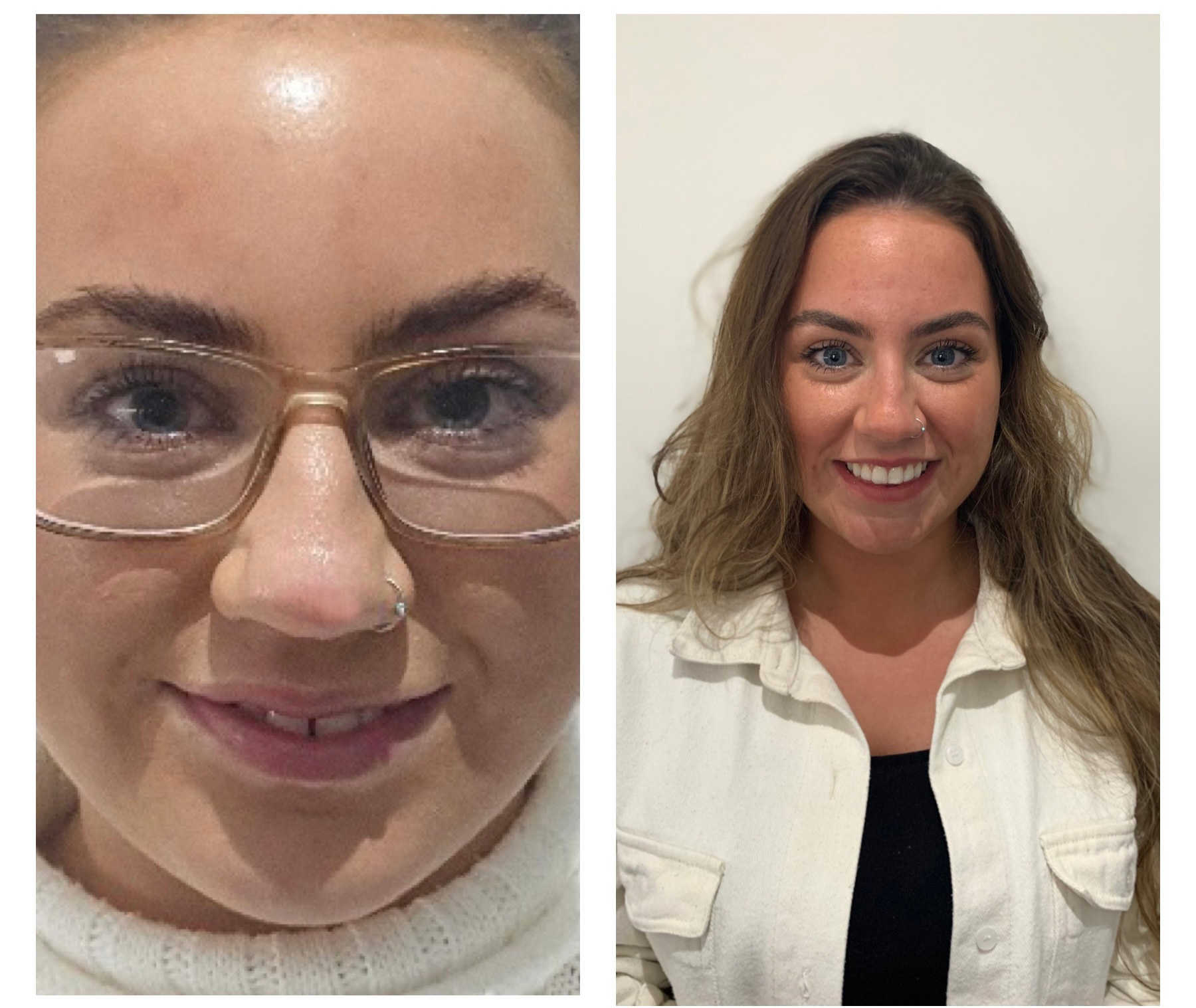 Invisalign Glasgow