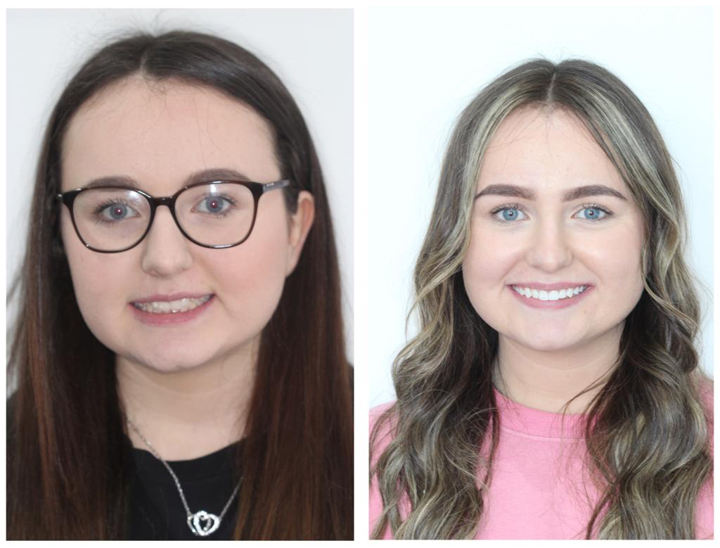 Invisalign Glasgow